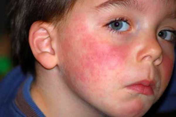 Аллергия на свинину симптомы